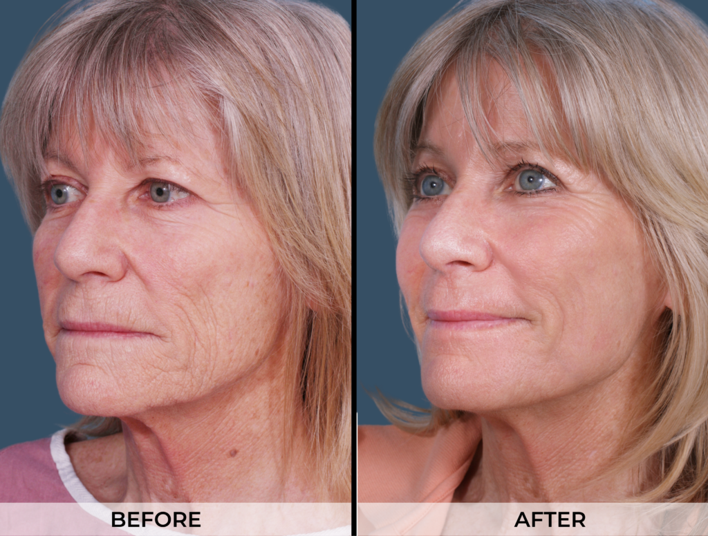 Brow Lift Gallery (Patient A)