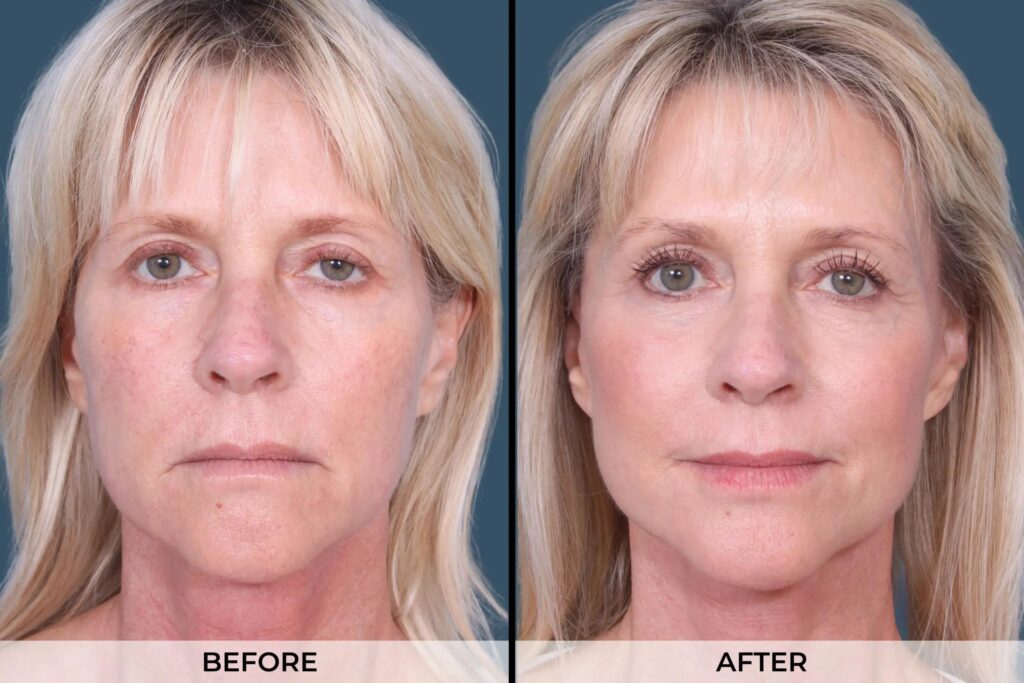 Facelift-Gallery-Patient-A-Front-scaled