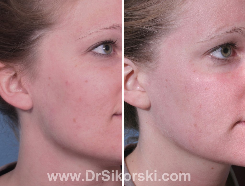 Fraxel-Laser-Orange-County-Patient-1-3