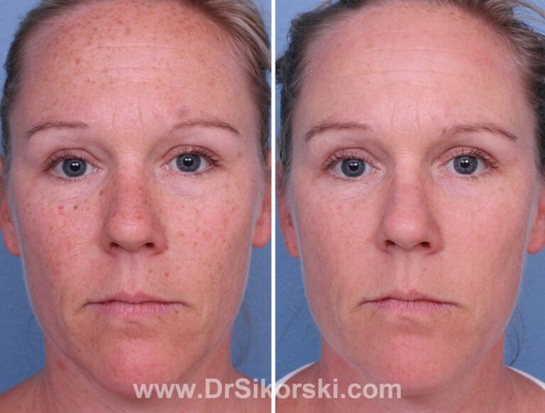 PhotoDerm Treatment for Brown and Red Spots