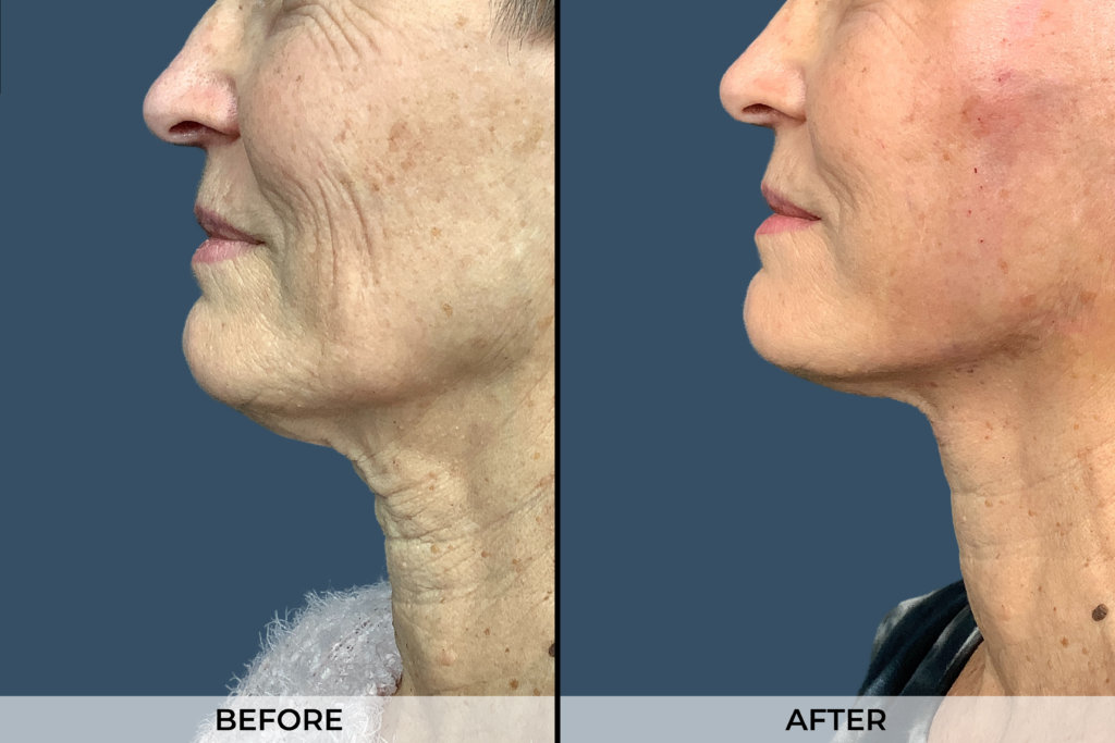Jowl Lift Gallery (Patient A)