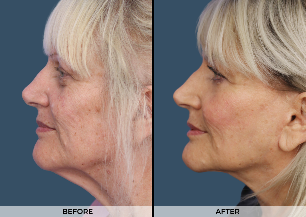 Neck Lift Gallery (Patient A)