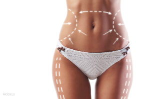 How Long Do The Results From CoolSculpting Last?