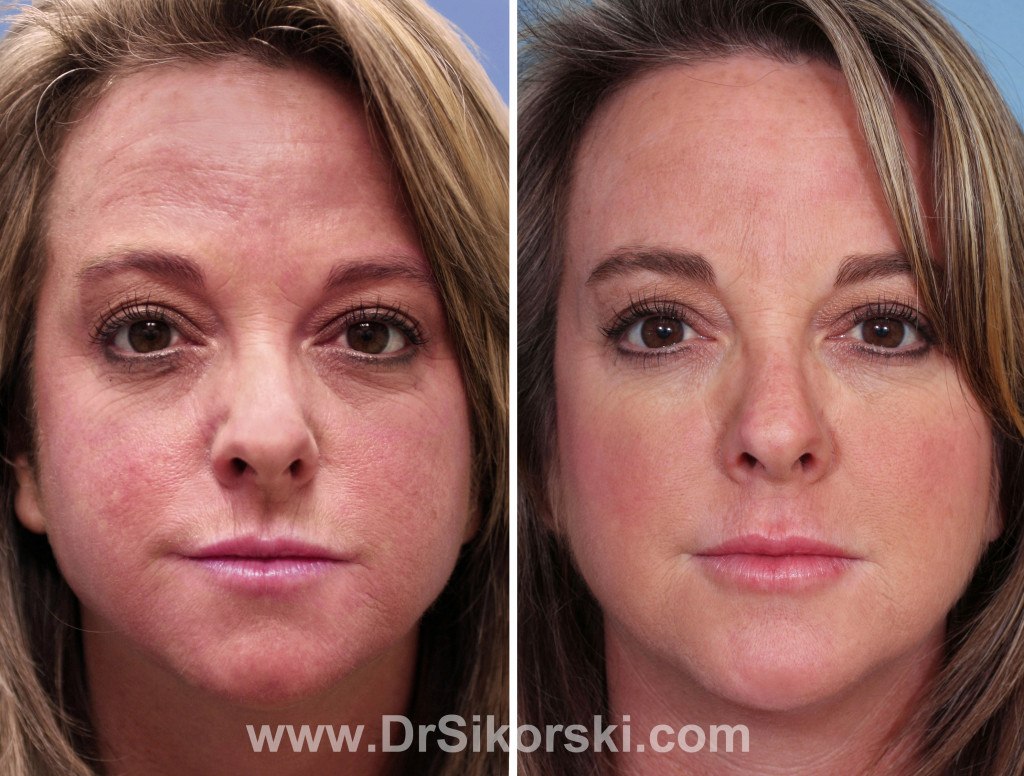 Chemical-Peels-Orange-County-Patient-1-2
