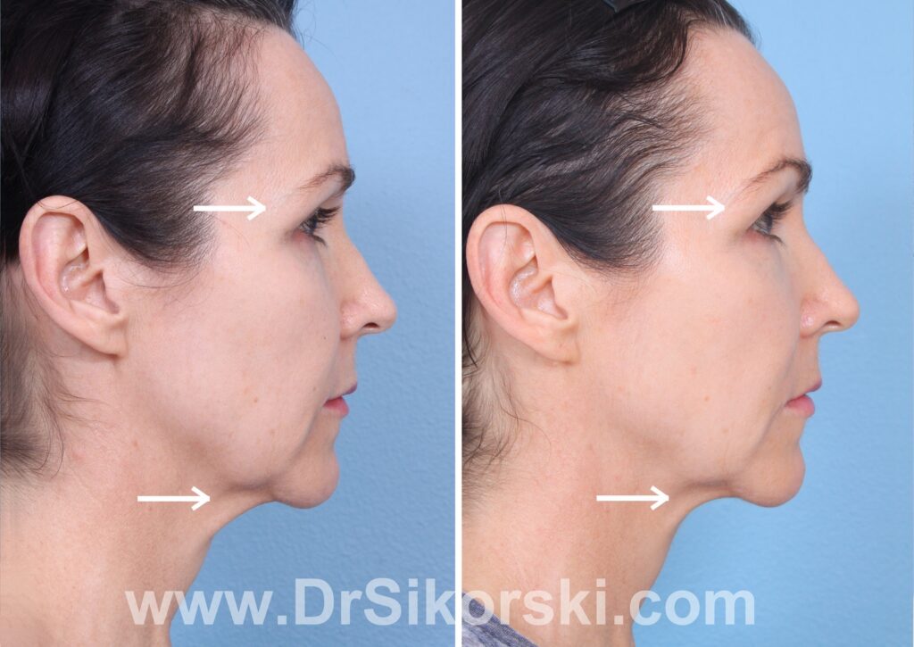 Ultherapy-Orange-County-Patient-2