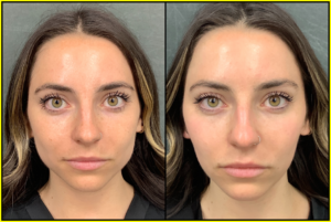 Woman with brown hair after Botox treatment