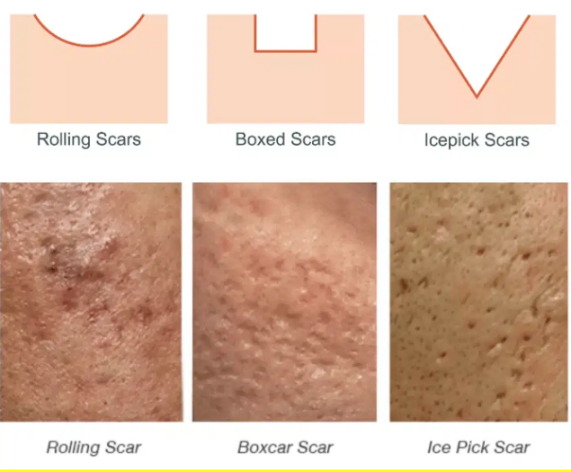 Diagram and examples of acne scars