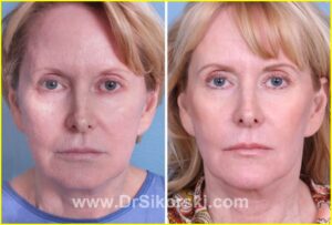 Results of Ultherapy treatment