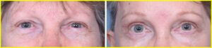 Results of lower eyelid lift