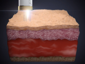 Skin diagram with Pico Laser