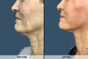 Jowl-Lift-Gallery-Patient-A